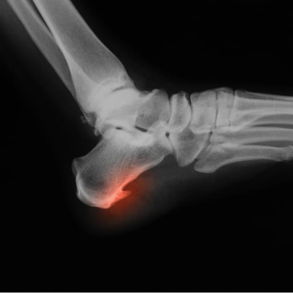 inflamed heel spur